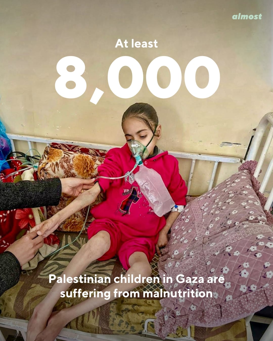 gaza children malnutrition