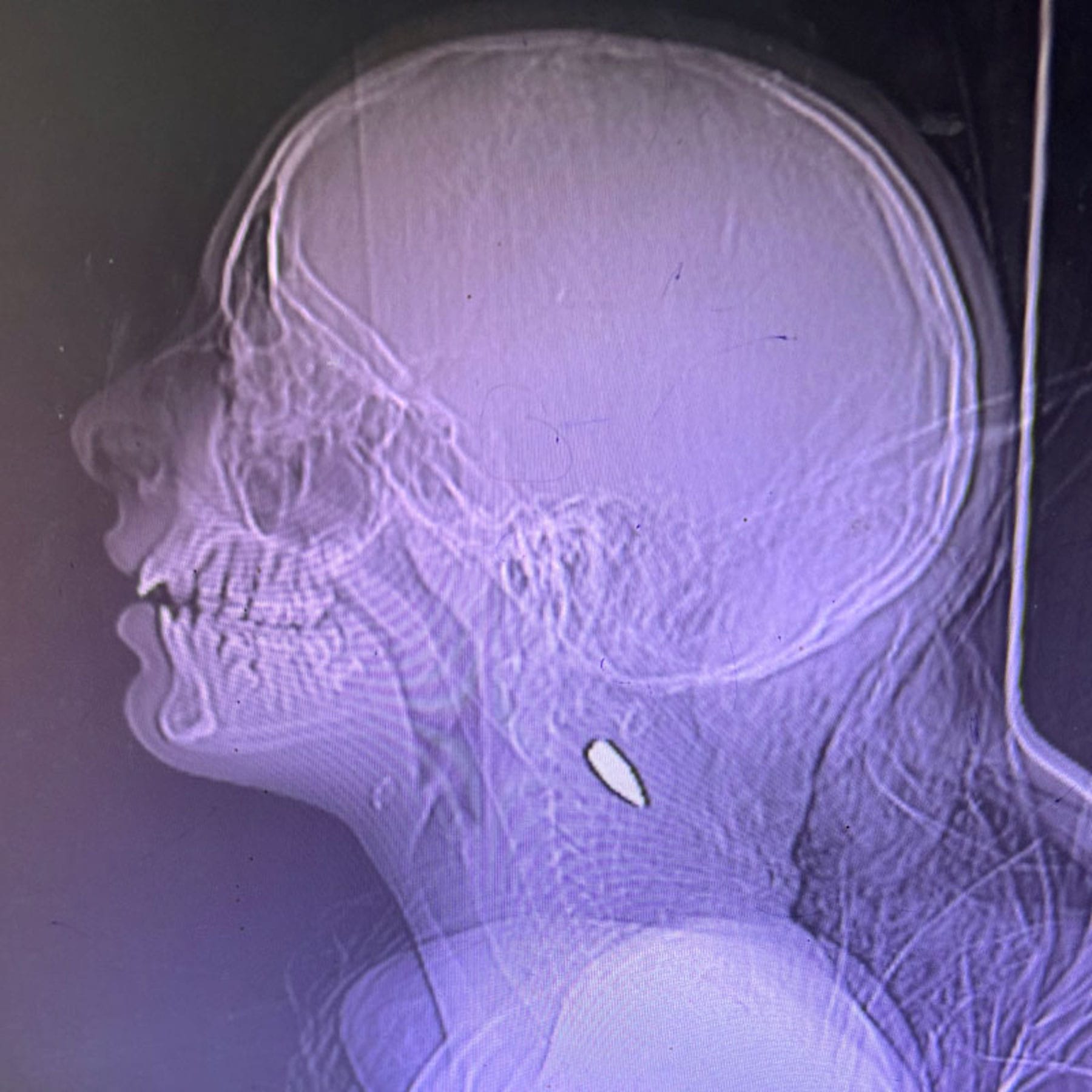 x-rays of pediatric pateints in Gaza