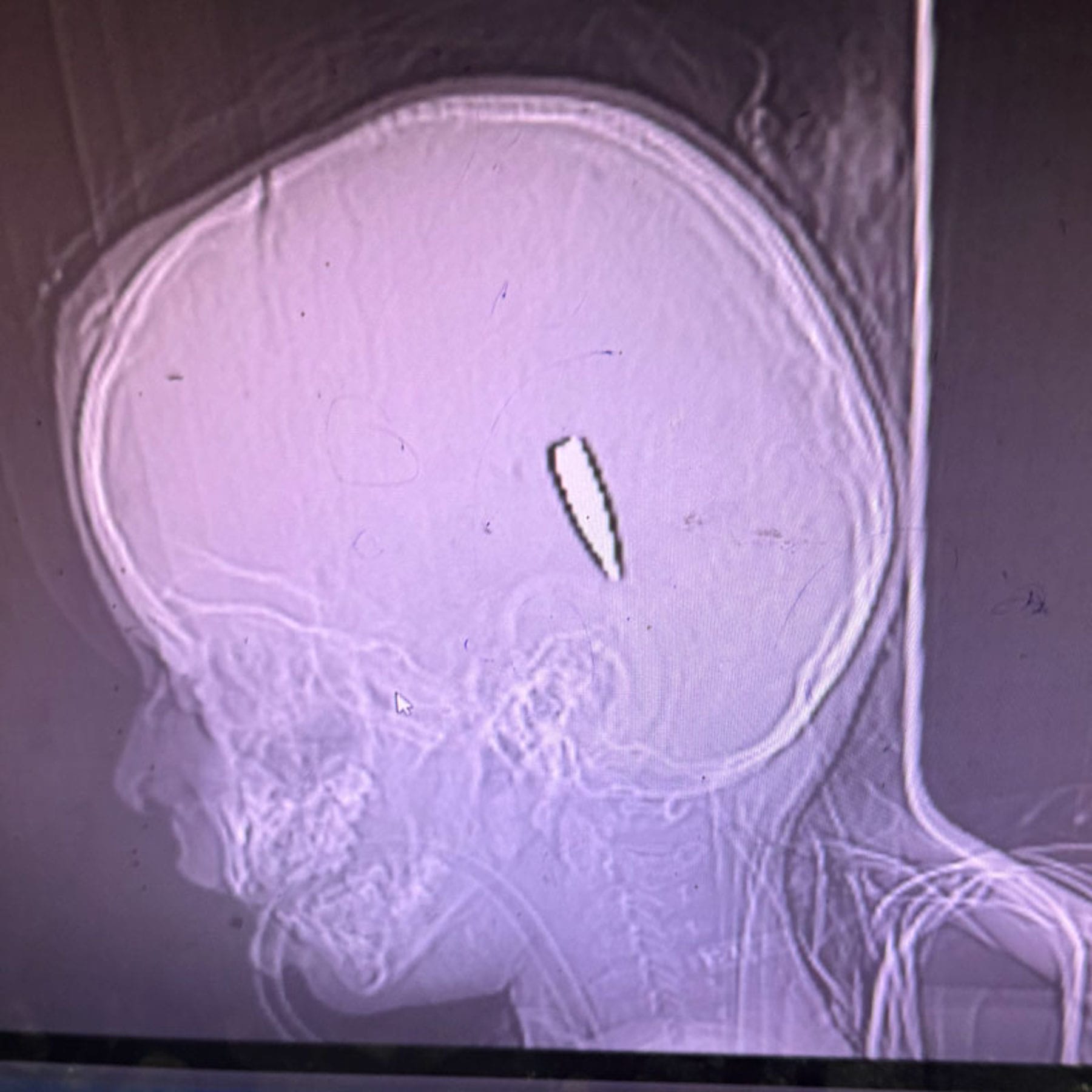 x rays of young children in Gaza