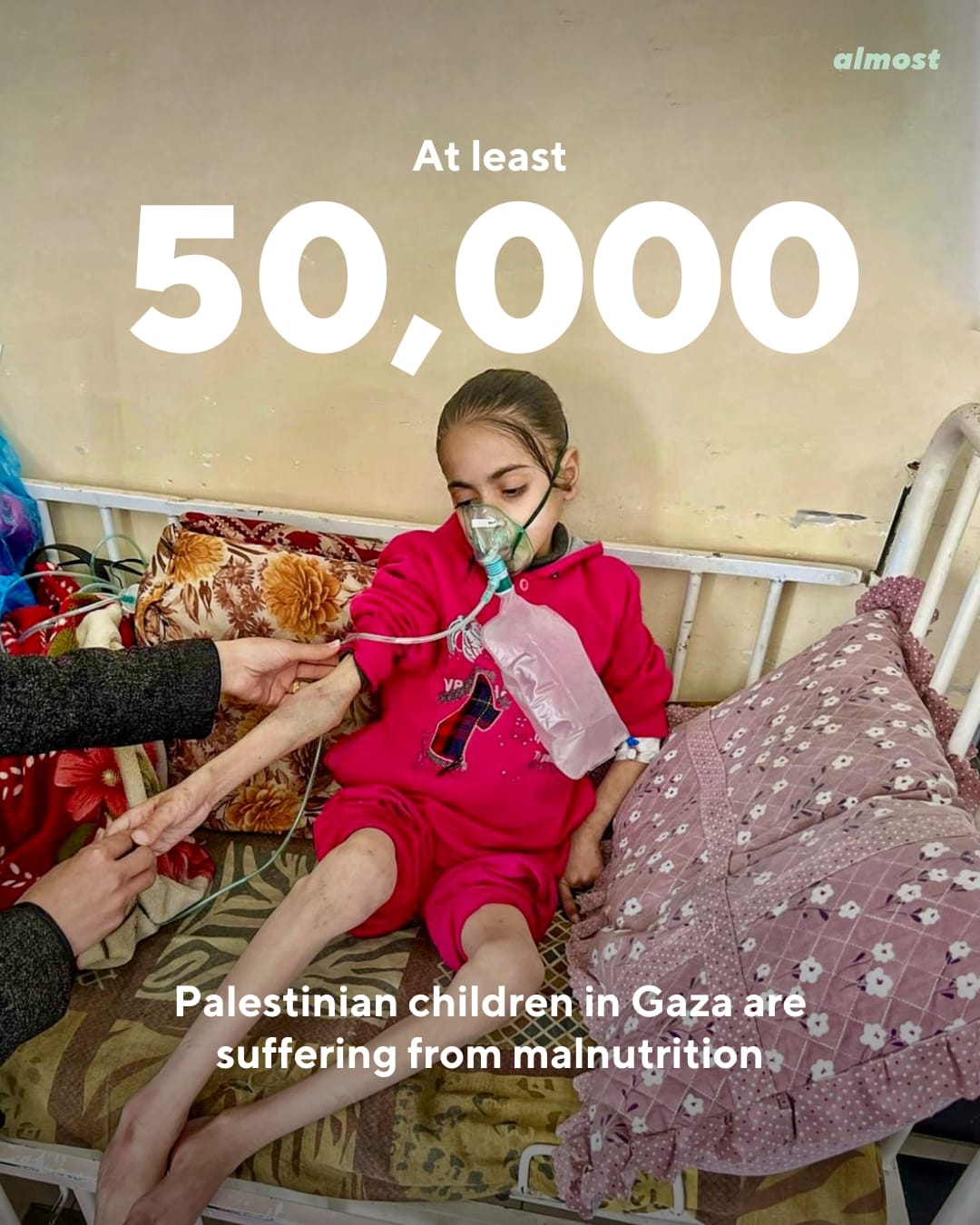 gaza children malnutrition israel genocide