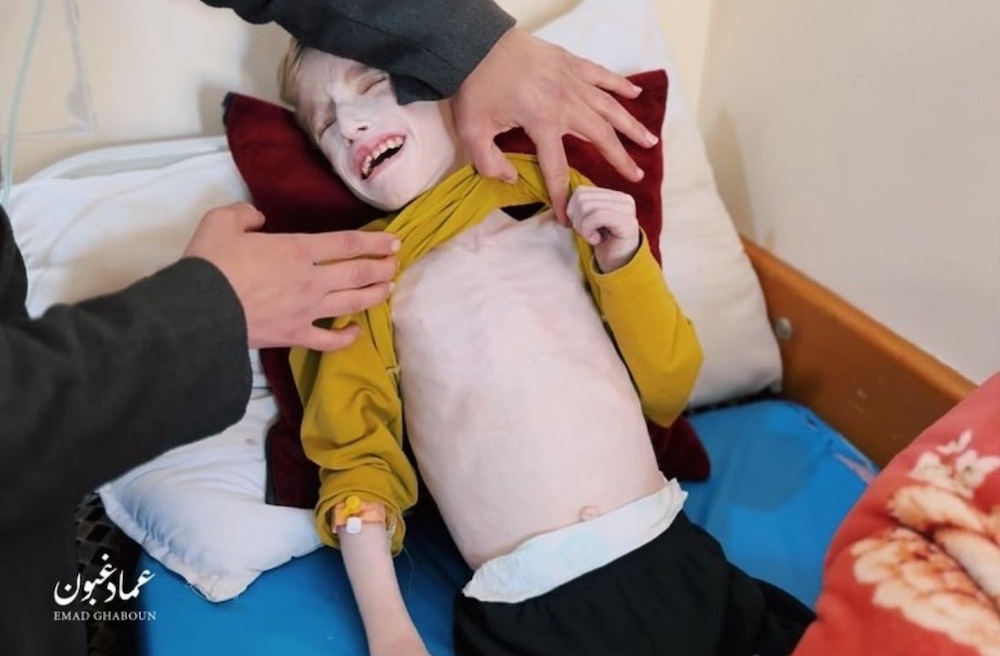 gaza childeren suffer malnutrition israel
