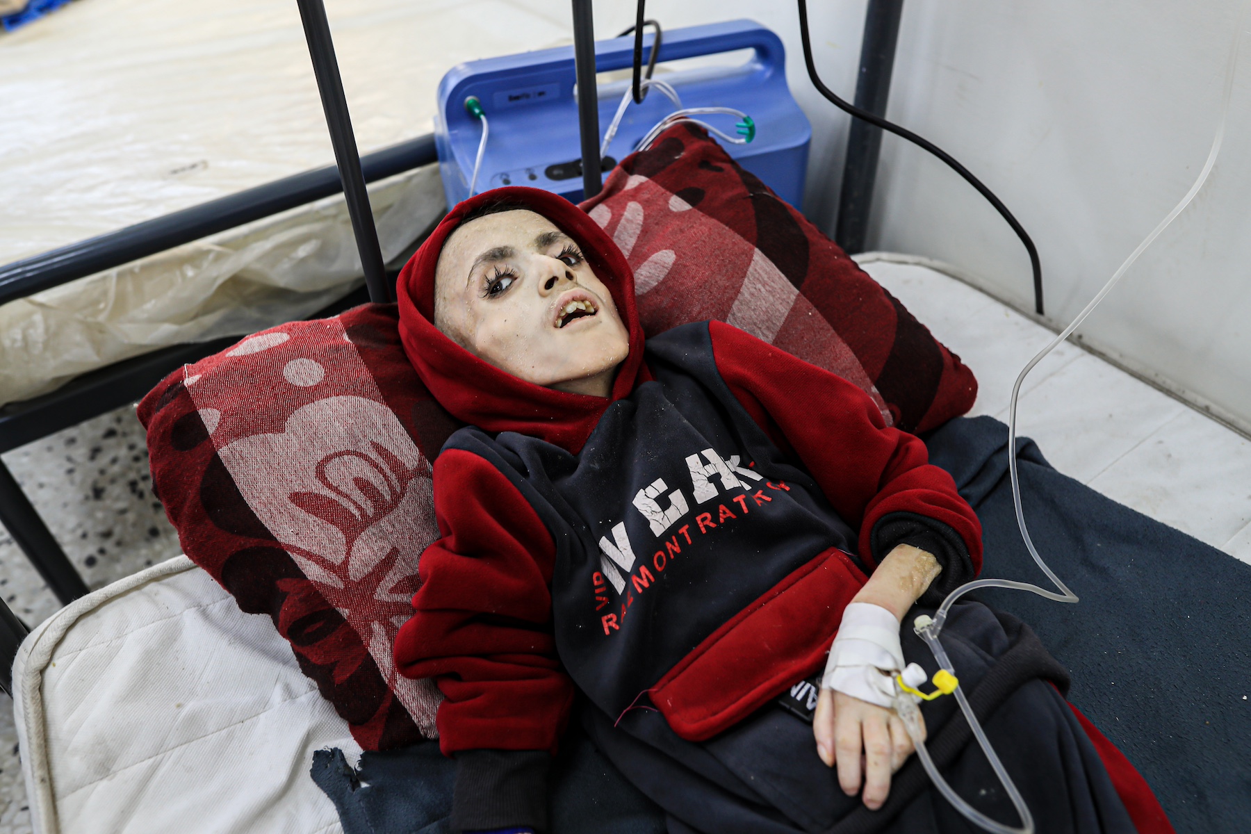 Yezen Al Kfarna Palestinian boy suffers malnourishment gaza israel